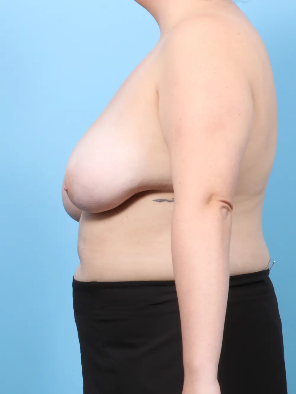 Breast Lift/Reduction w/o Implants Patient Photo - Case 58949 - before view-2