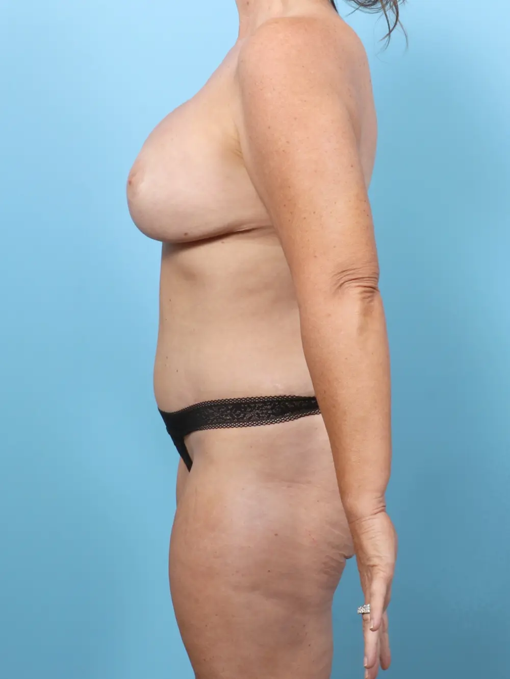Breast Lift/Reduction with Implants Patient Photo - Case 58984 - after view-2