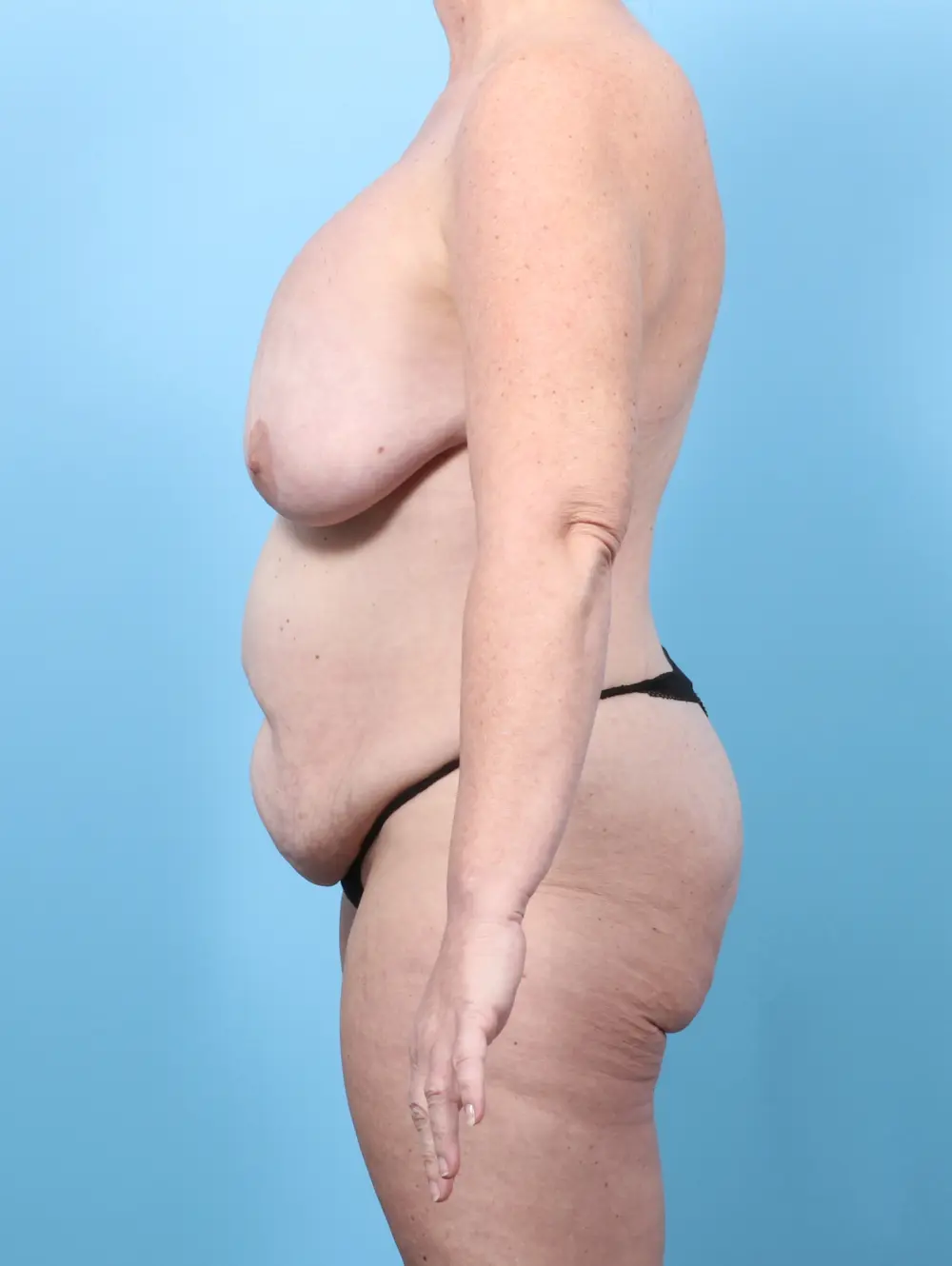 Breast Lift/Reduction with Implants Patient Photo - Case 58984 - before view-2