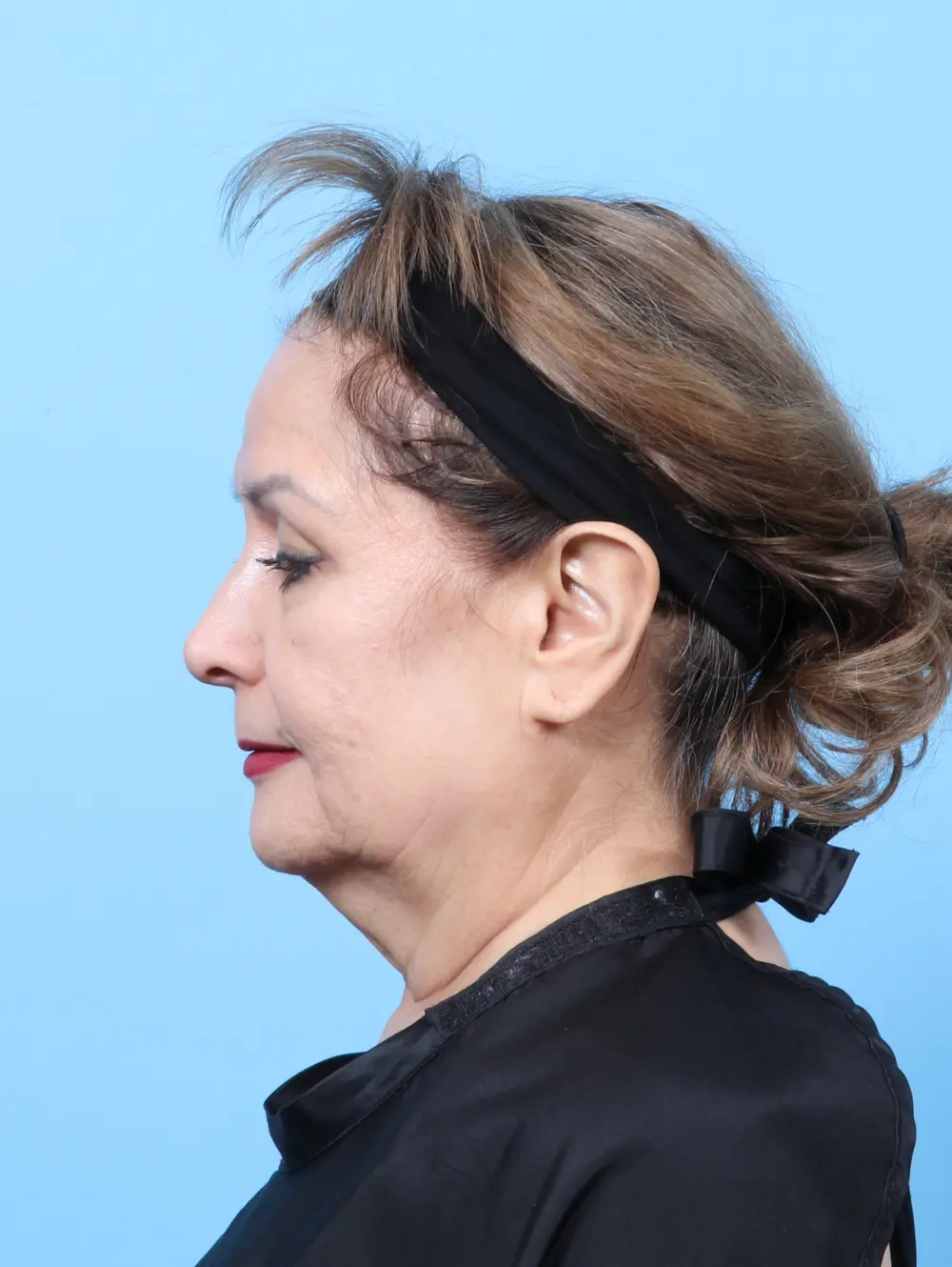 Laser Resurfacing Patient Photo - Case 59050 - before view-2