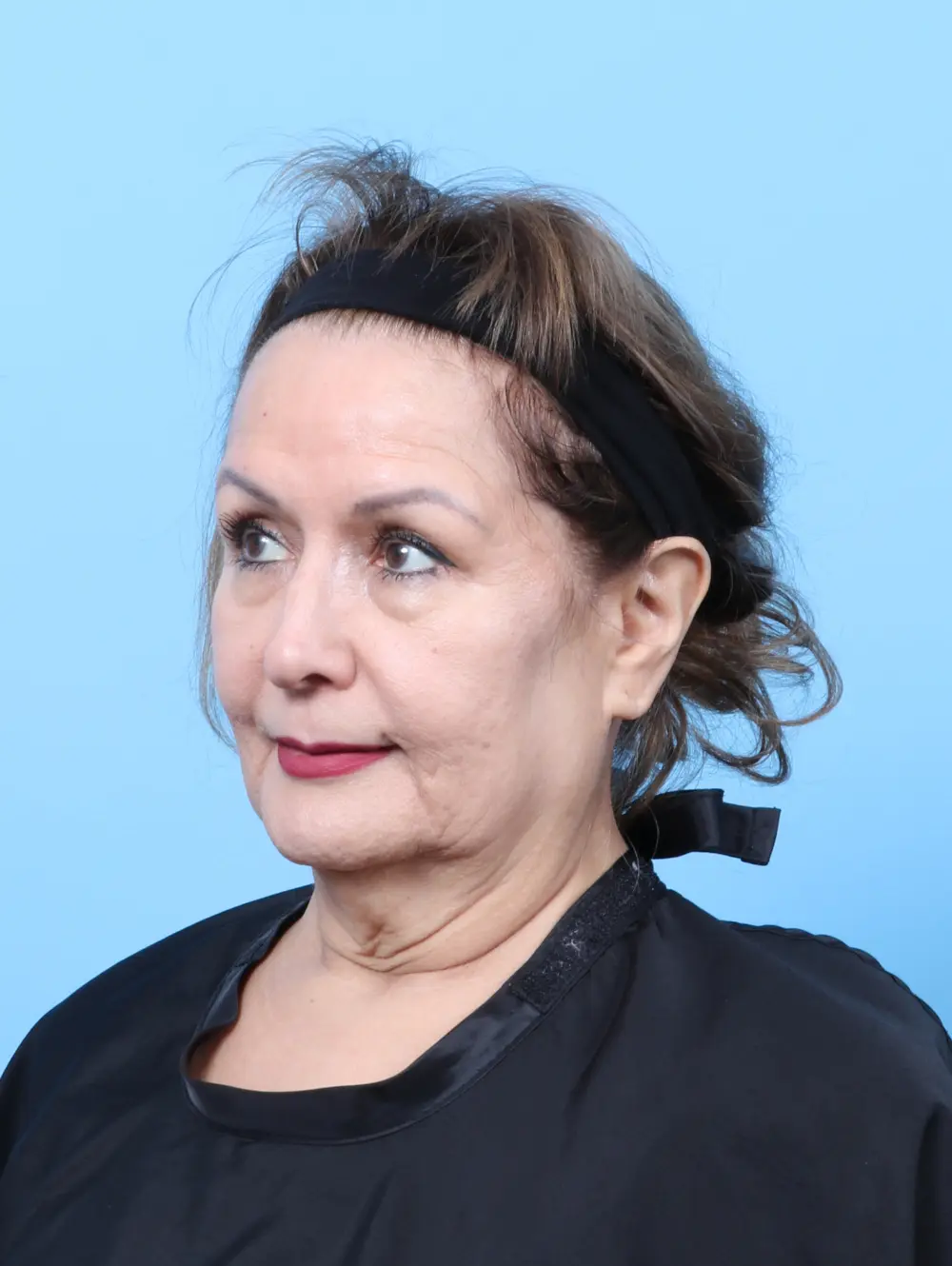 Laser Resurfacing Patient Photo - Case 59050 - before view-1