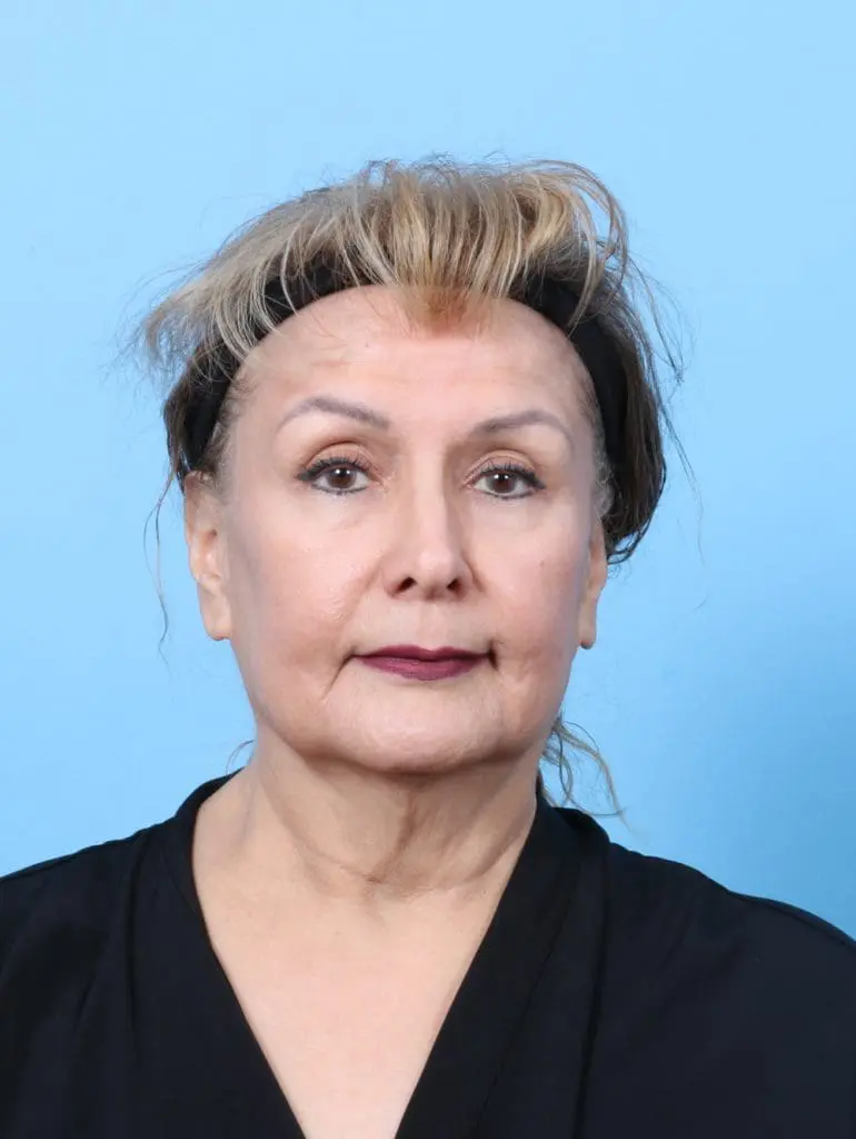 Laser Resurfacing - Case 59050 - After