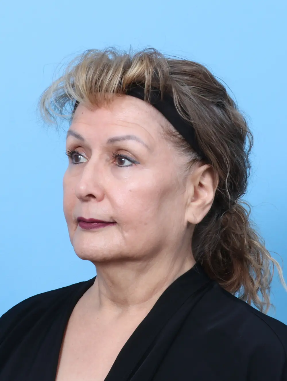 Laser Resurfacing Patient Photo - Case 59050 - after view-1