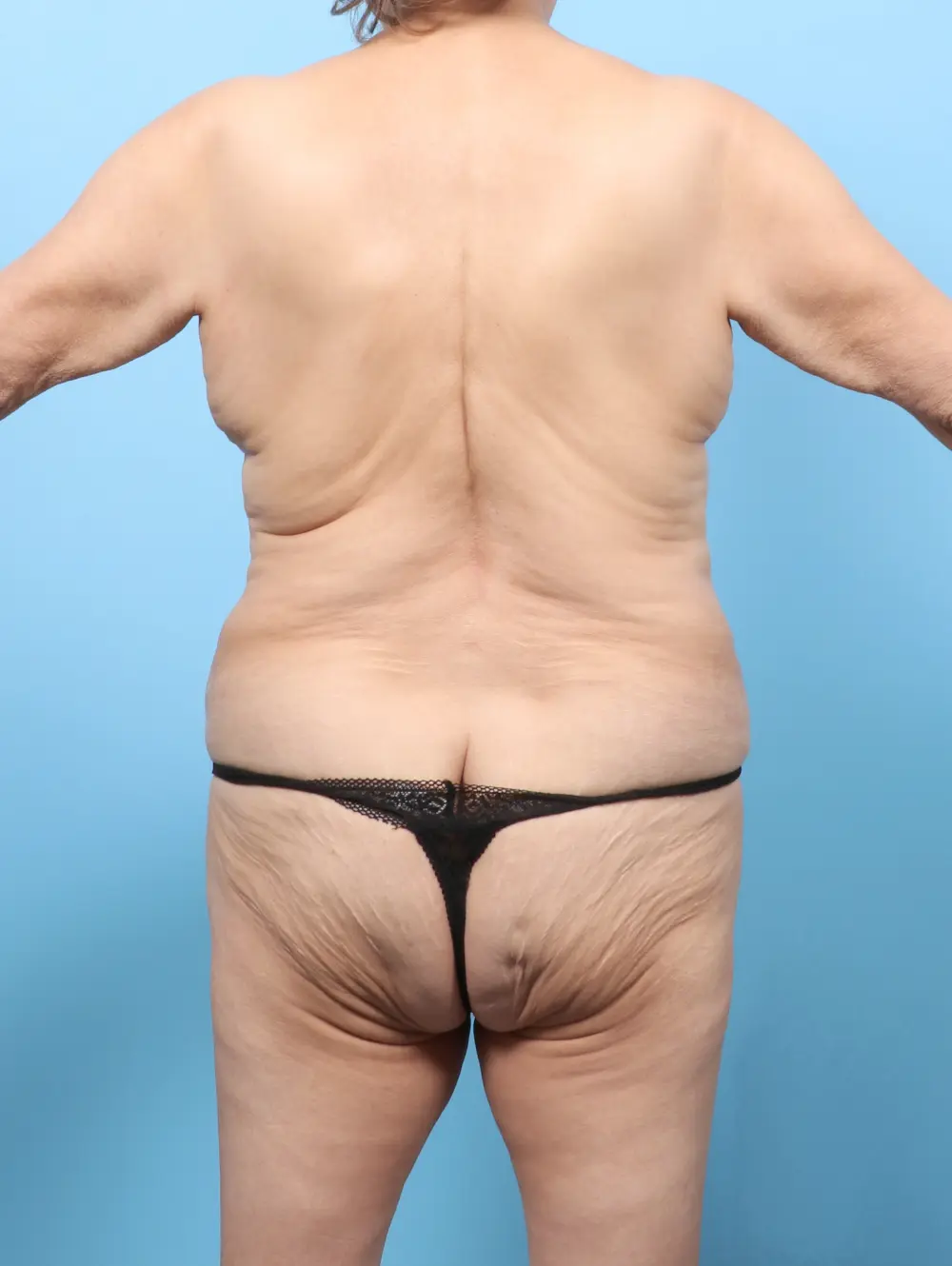 After Weight Loss Patient Photo - Case 59000 - before view-3