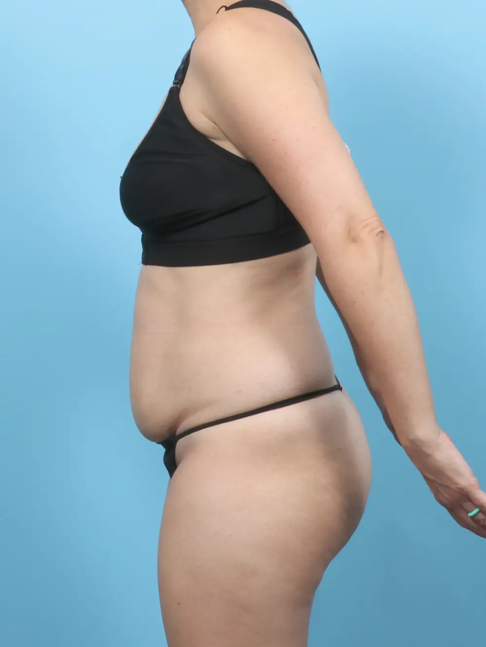Tummy Tuck Patient Photo - Case 59024 - before view-2