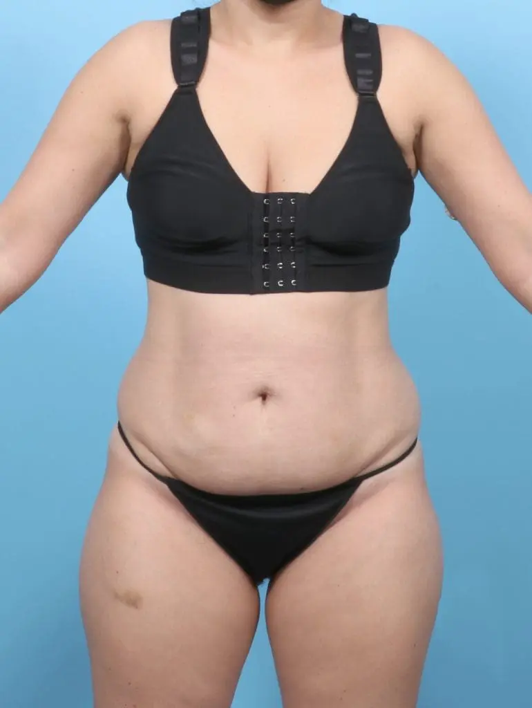 Tummy Tuck - Case 59024 - Before