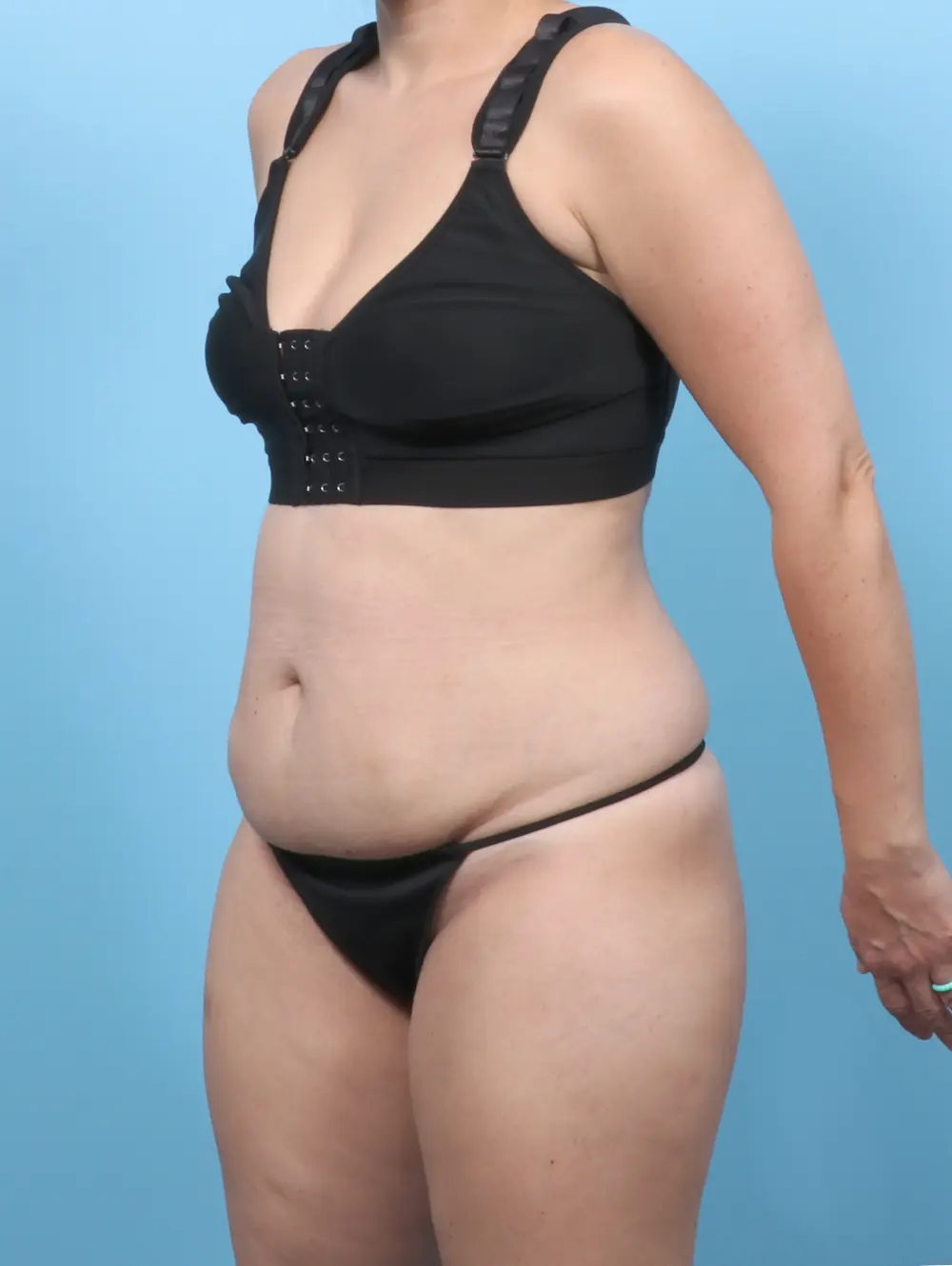 Tummy Tuck Patient Photo - Case 59024 - before view-1