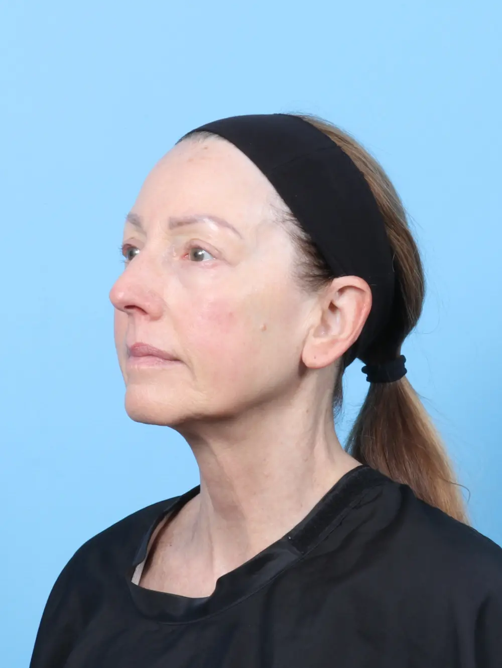 Eyelid Surgery Patient Photo - Case 59032 - after view-1