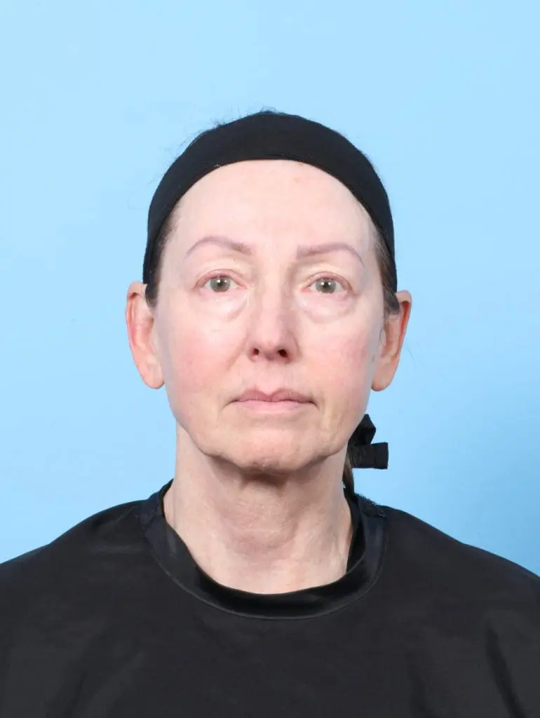 Eyelid Surgery - Case 59032 - Before