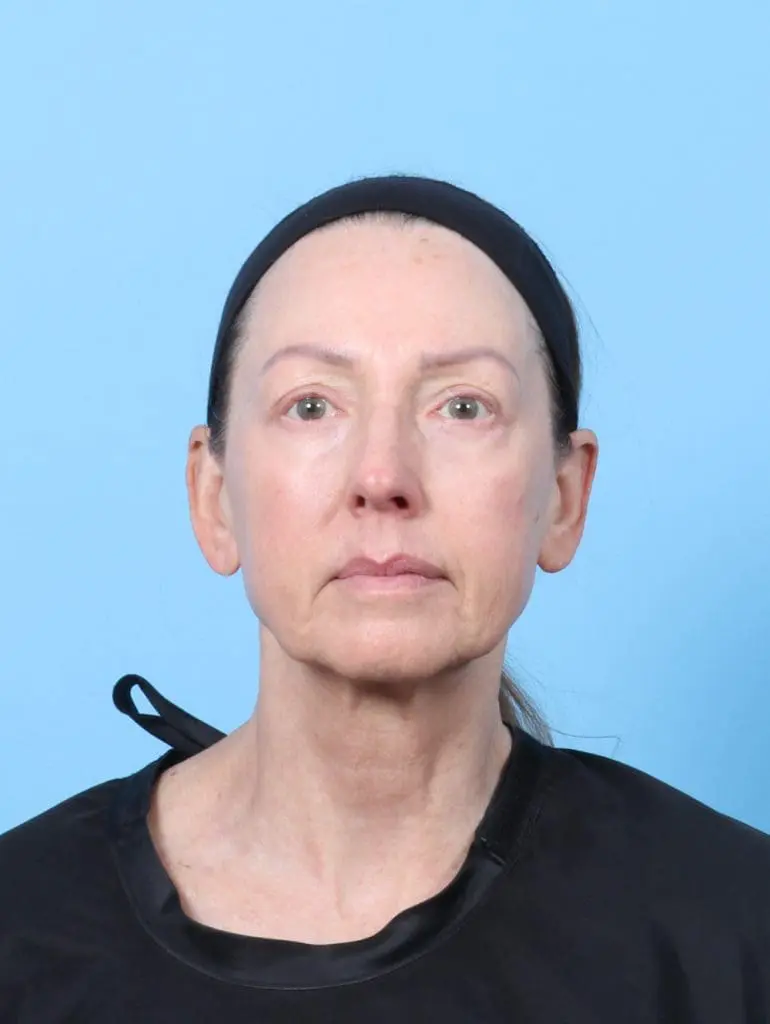 Eyelid Surgery - Case 59032 - After