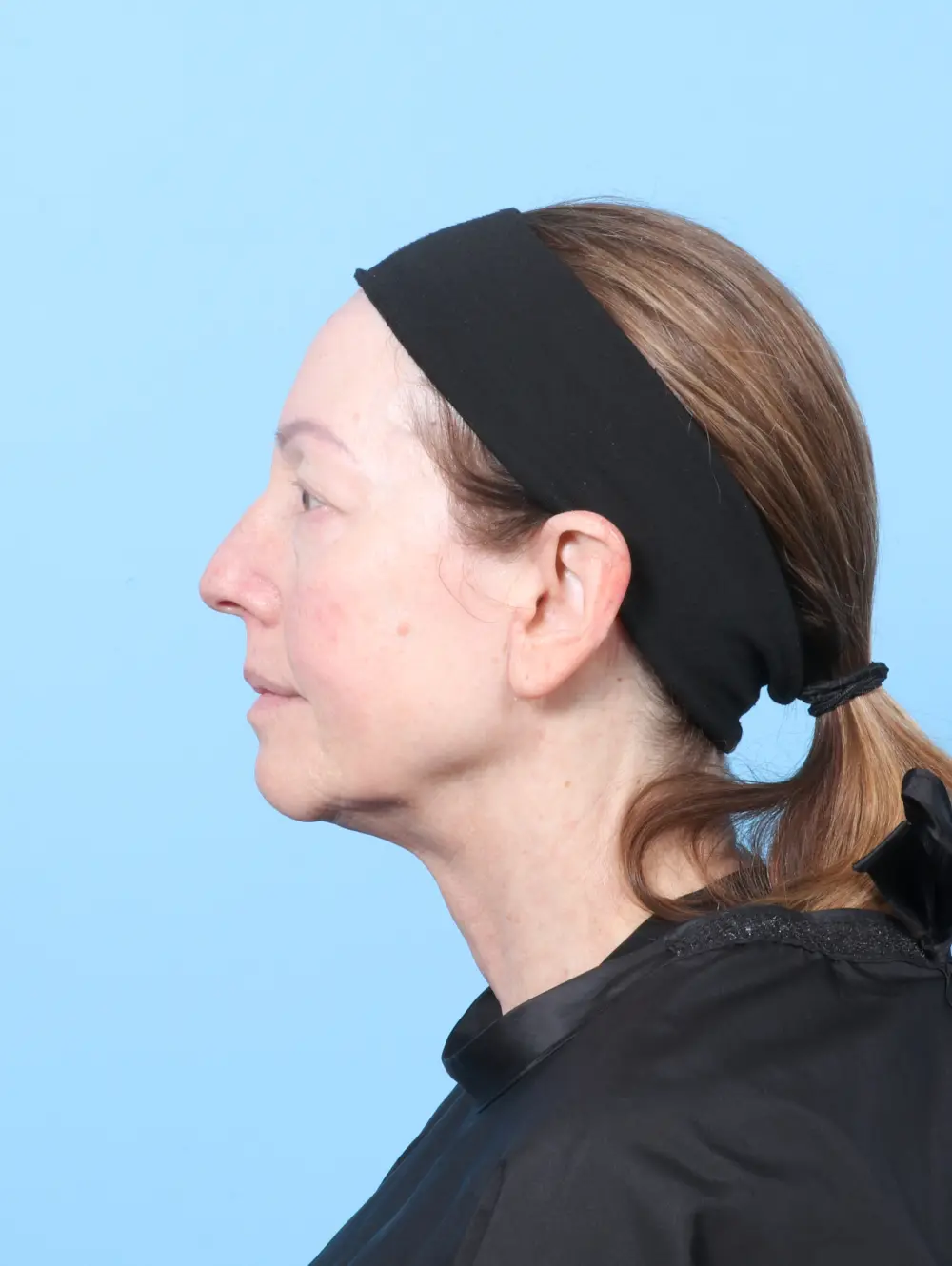 Eyelid Surgery Patient Photo - Case 59032 - before view-2