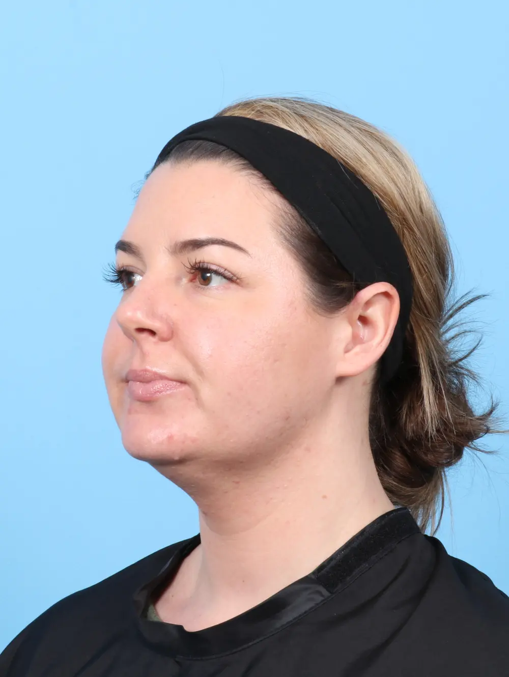 Liposuction Patient Photo - Case 59060 - before view-1
