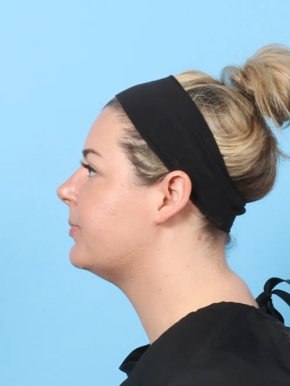 Liposuction Patient Photo - Case 59060 - after view-2