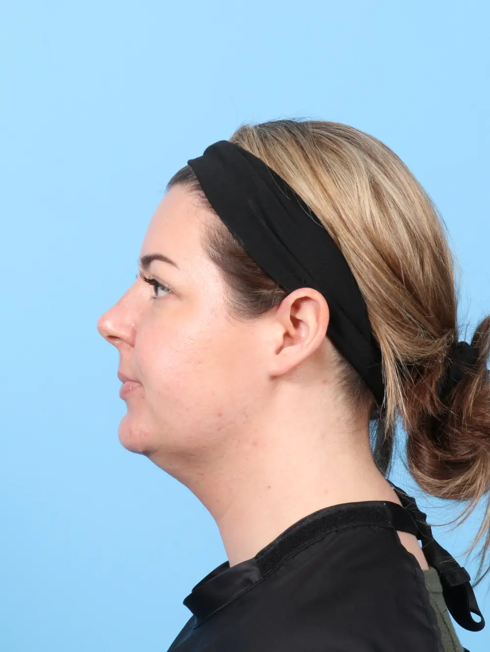 Liposuction Patient Photo - Case 59060 - before view-2