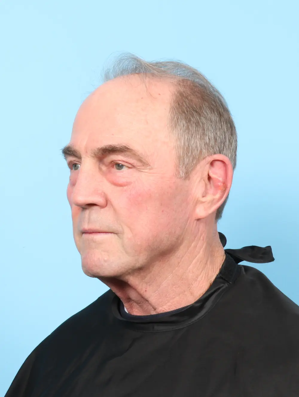 Eyelid Surgery Patient Photo - Case 59076 - before view-1