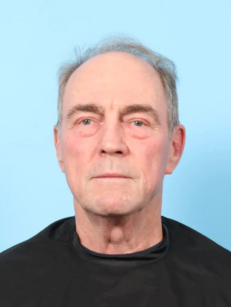 Eyelid Surgery - Case 59076 - Before