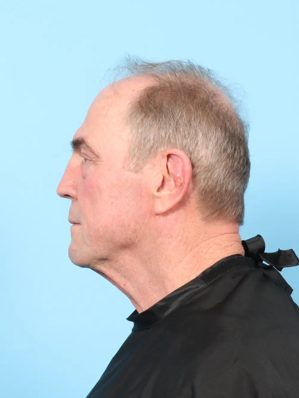 Eyelid Surgery Patient Photo - Case 59076 - before view-2