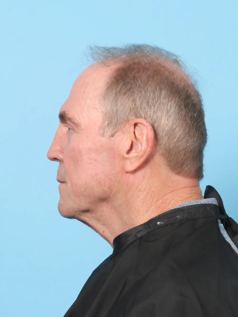 Eyelid Surgery Patient Photo - Case 59076 - after view-2