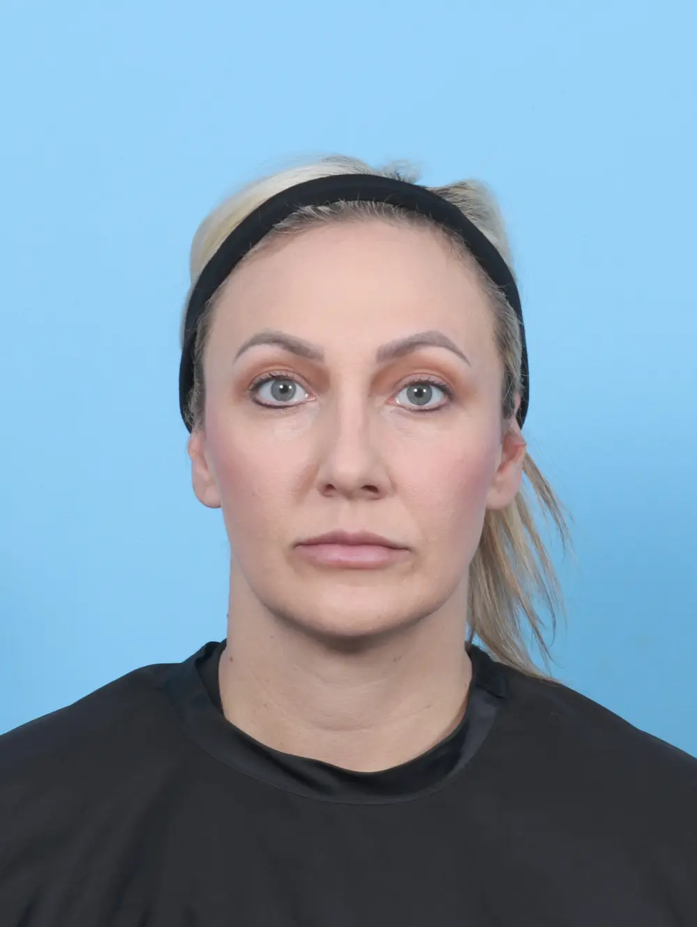 Rhinoplasty Patient Photo - Case 59128 - after view-2