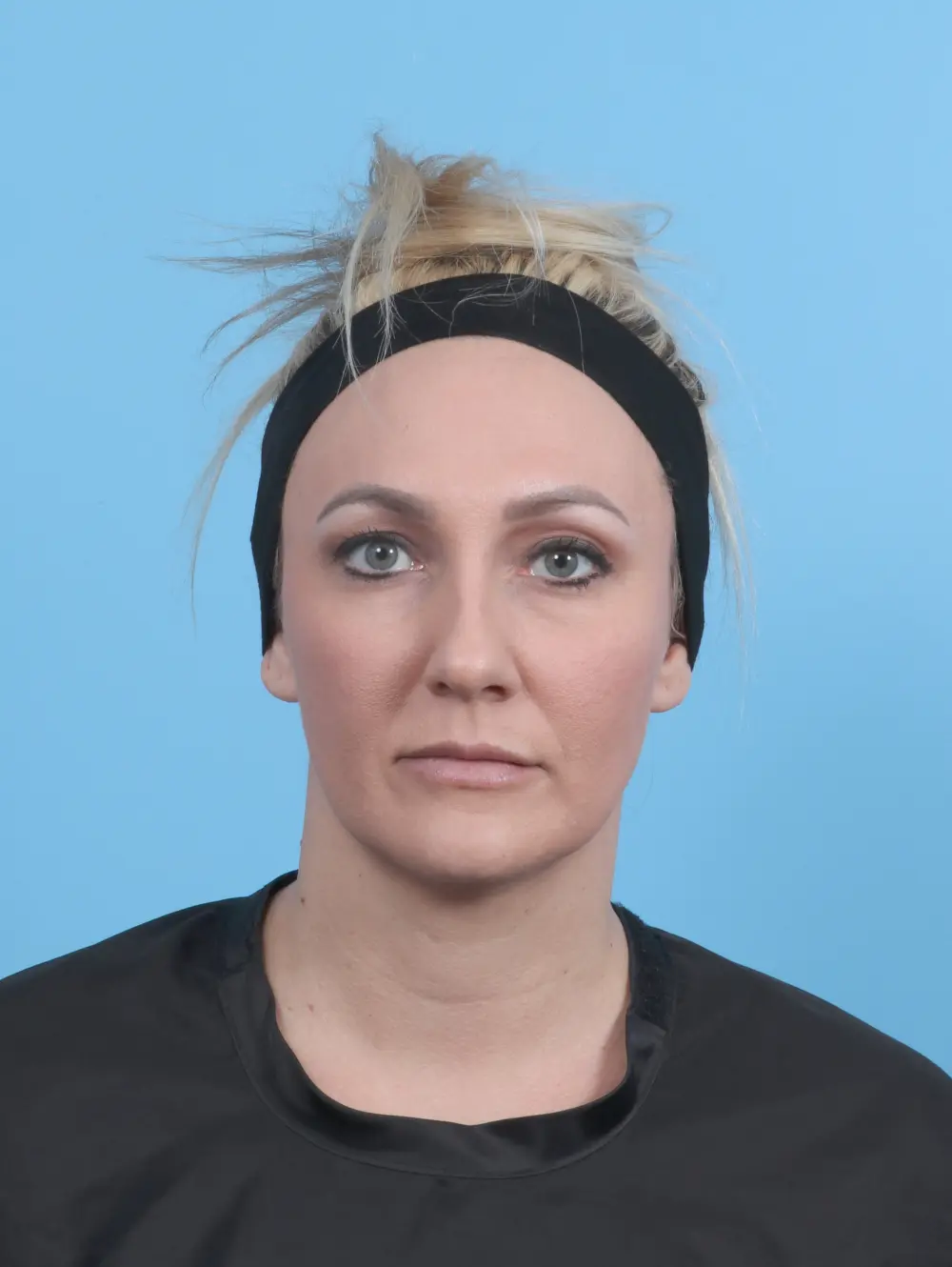 Rhinoplasty Patient Photo - Case 59128 - before view-2