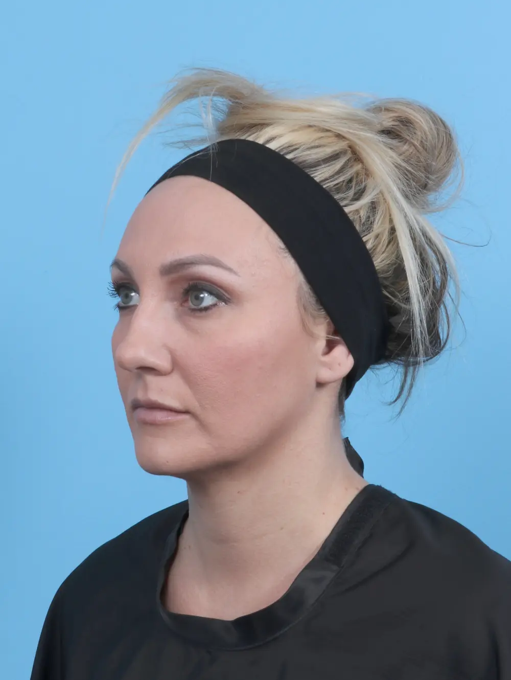 Rhinoplasty Patient Photo - Case 59128 - before view-1