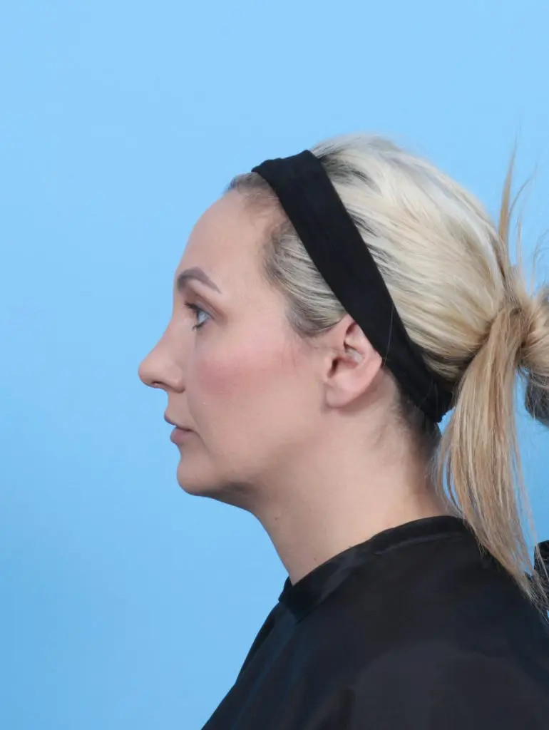 Rhinoplasty - Case 59128 - After