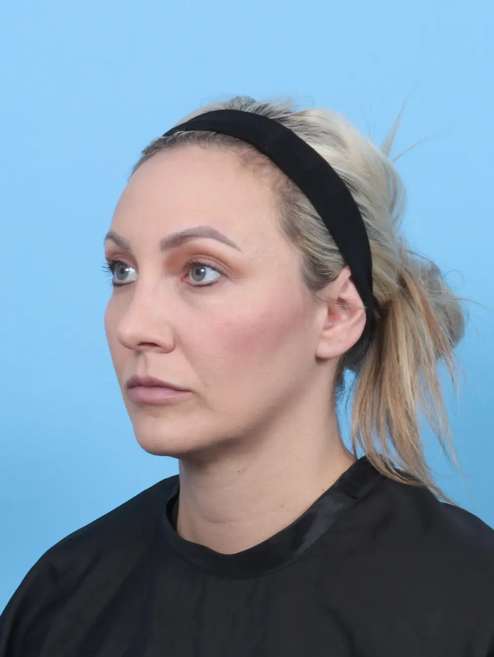 Rhinoplasty Patient Photo - Case 59128 - after view-1