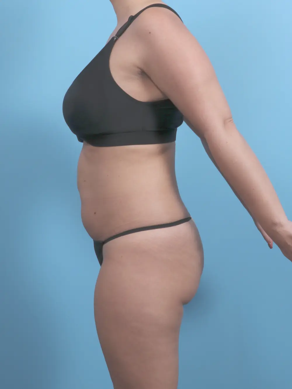 Tummy Tuck Patient Photo - Case 59136 - before view-2