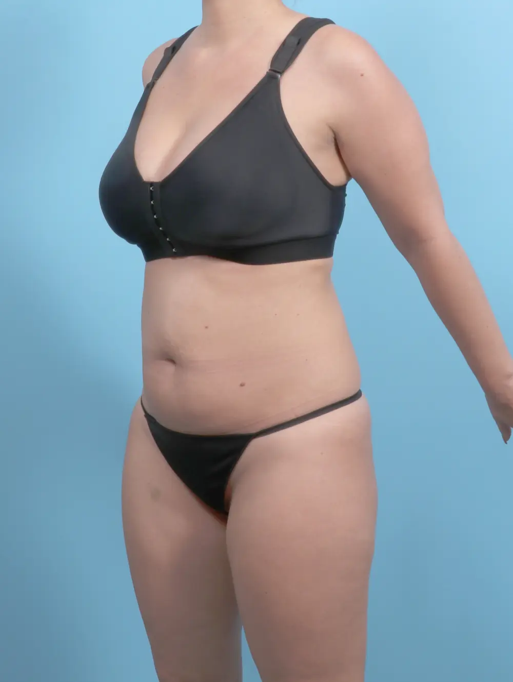 Tummy Tuck Patient Photo - Case 59136 - before view-1