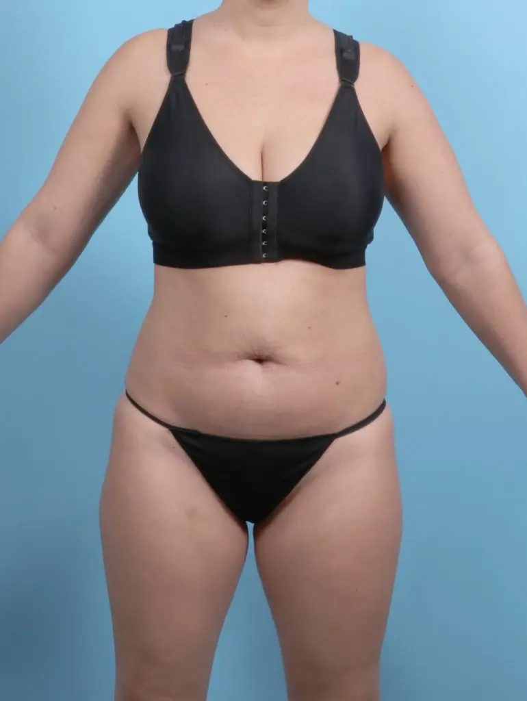 Tummy Tuck - Case 59136 - Before