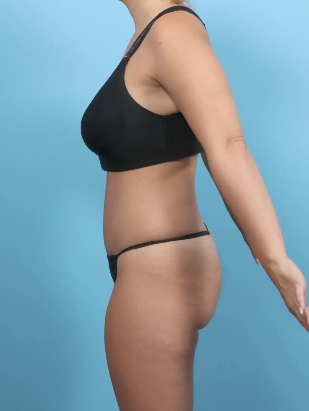 Tummy Tuck Patient Photo - Case 59136 - after view-2