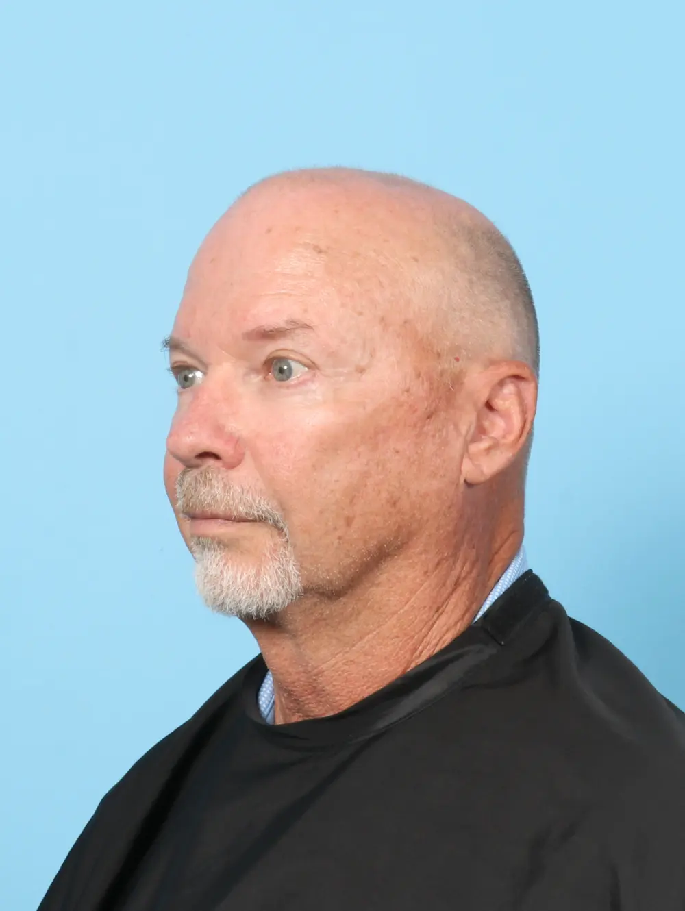 Eyelid Surgery Patient Photo - Case 59160 - after view-1