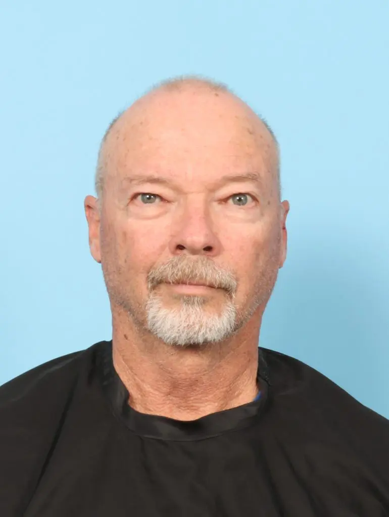 Eyelid Surgery - Case 59160 - Before