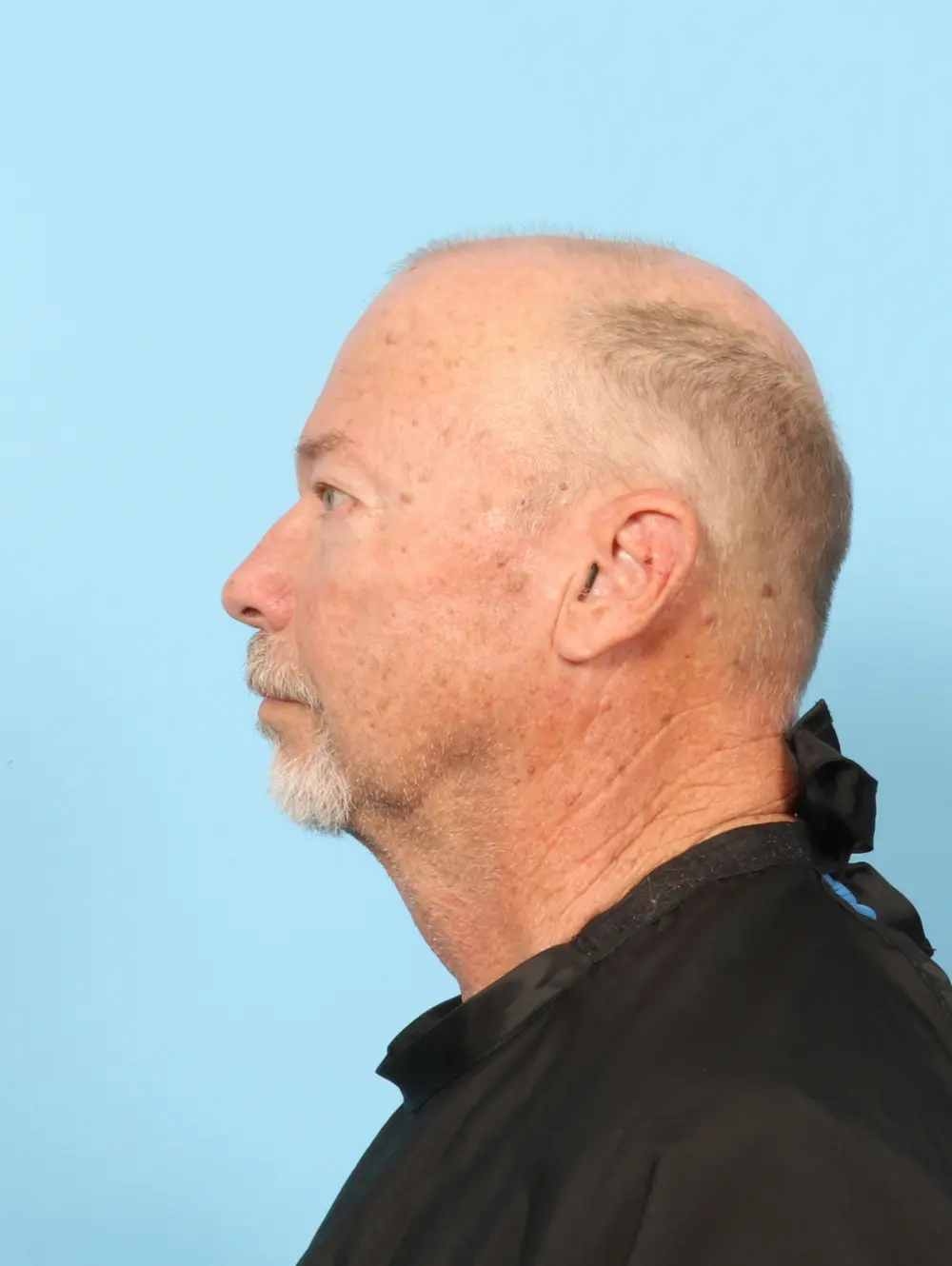 Eyelid Surgery Patient Photo - Case 59160 - before view-2