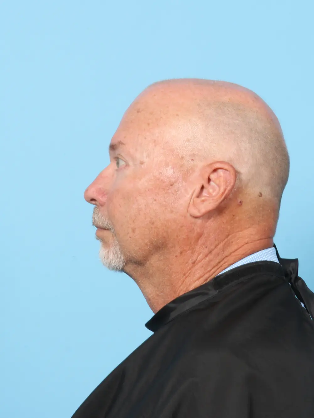 Eyelid Surgery Patient Photo - Case 59160 - after view-2