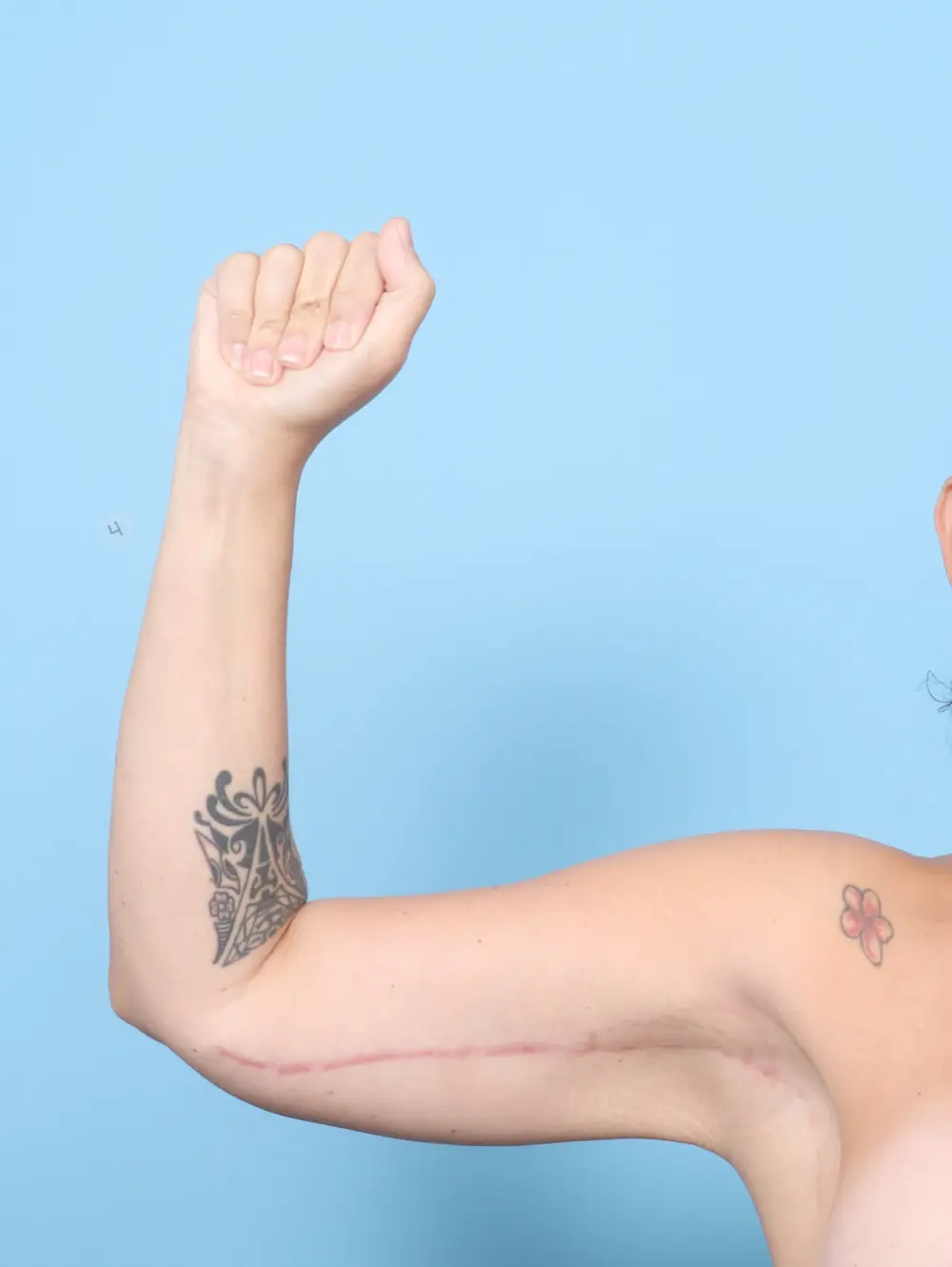 Arm Lift Patient Photo - Case 59181 - after view-1