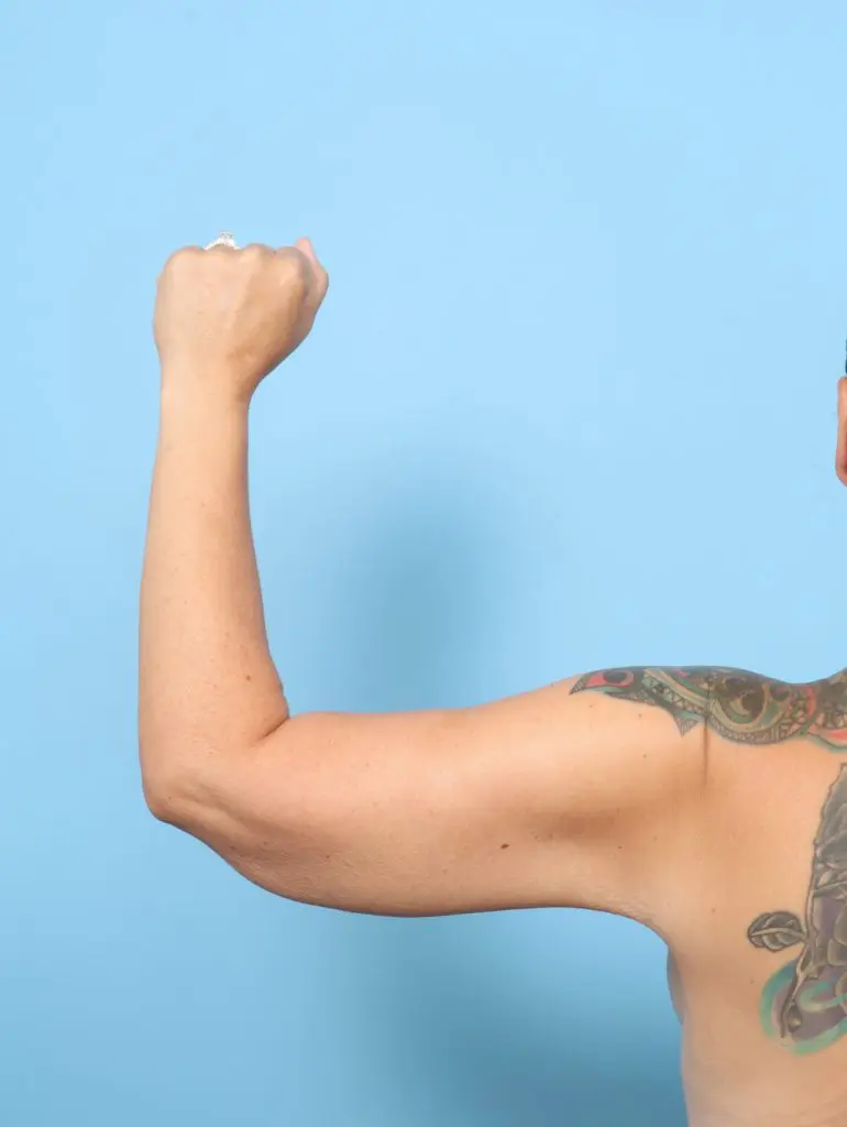 Arm Lift - Case 59181 - After