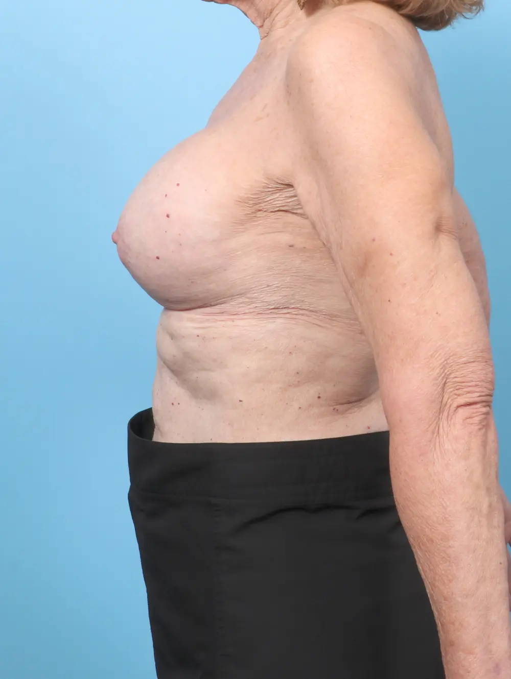 Breast Implant Revision Patient Photo - Case 59183 - after view-2