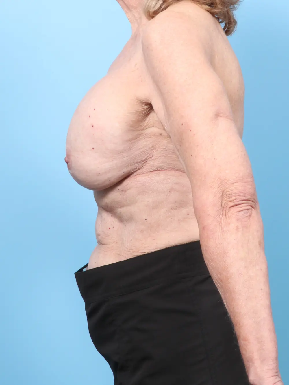 Breast Implant Revision Patient Photo - Case 59183 - before view-2