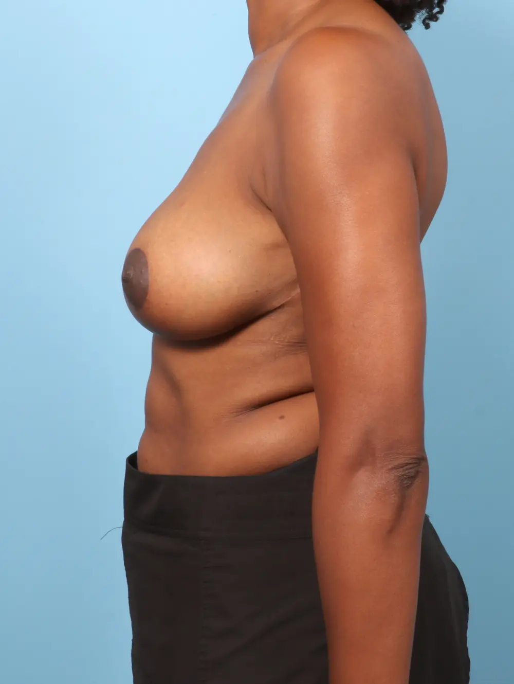 Breast Lift/Reduction with Implants Patient Photo - Case 59199 - after view-2