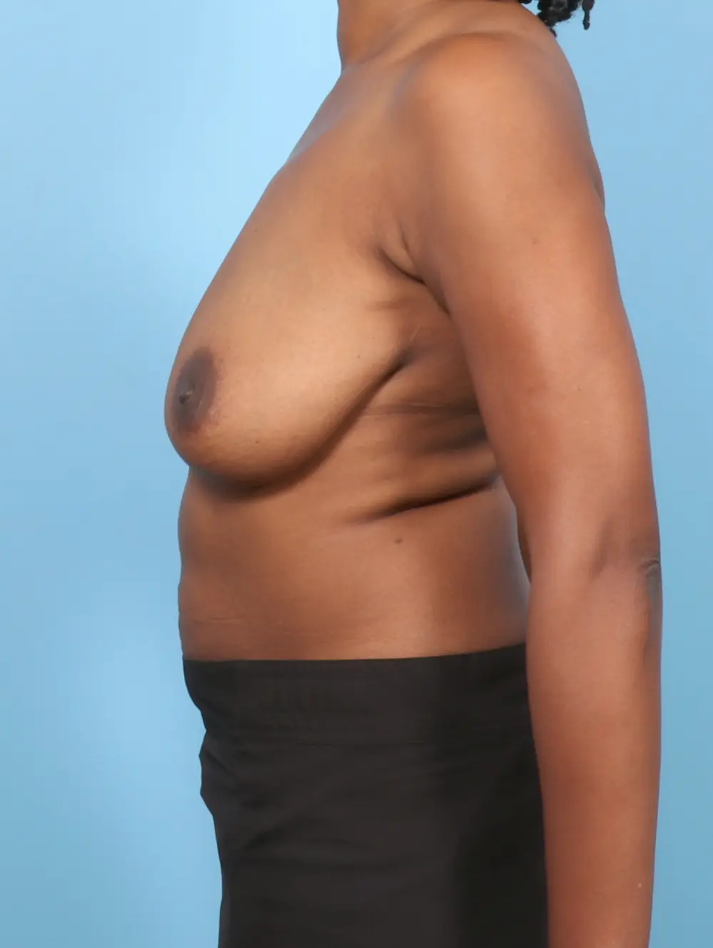 Breast Lift/Reduction with Implants Patient Photo - Case 59199 - before view-2