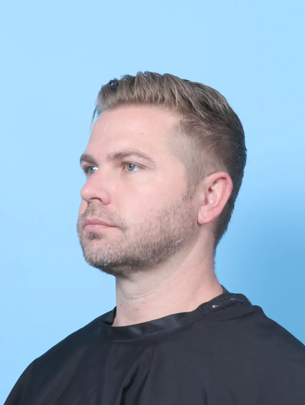 Anterior Neck Lift Patient Photo - Case 59207 - after view-2