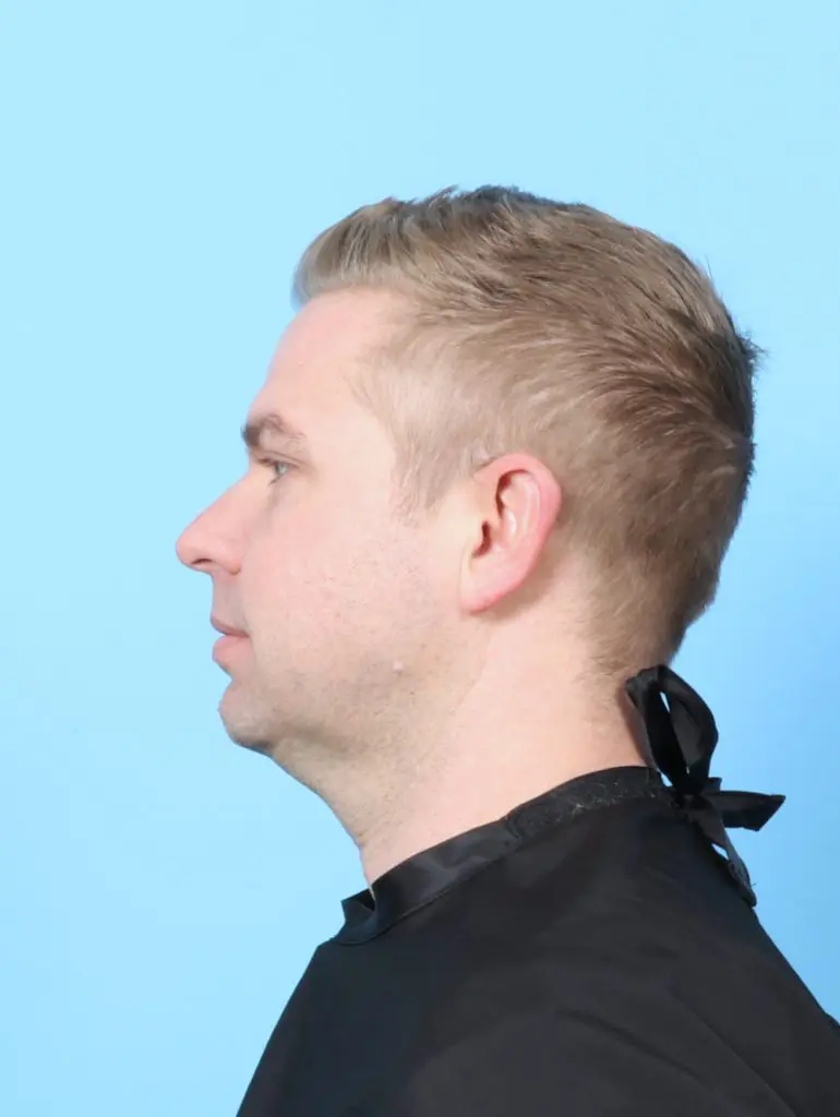 Anterior Neck Lift - Case 59207 - Before