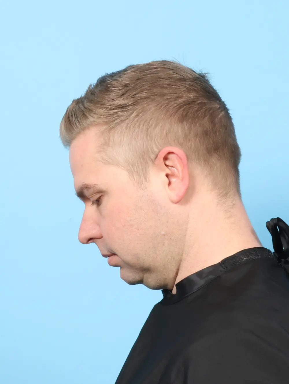 Anterior Neck Lift Patient Photo - Case 59207 - before view-1