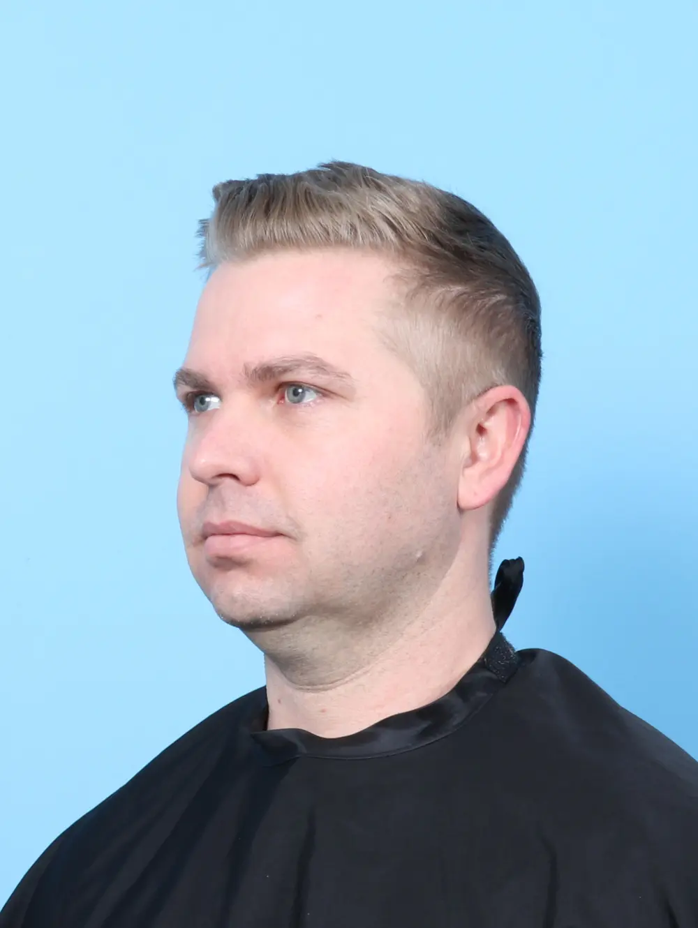 Anterior Neck Lift Patient Photo - Case 59207 - before view-2