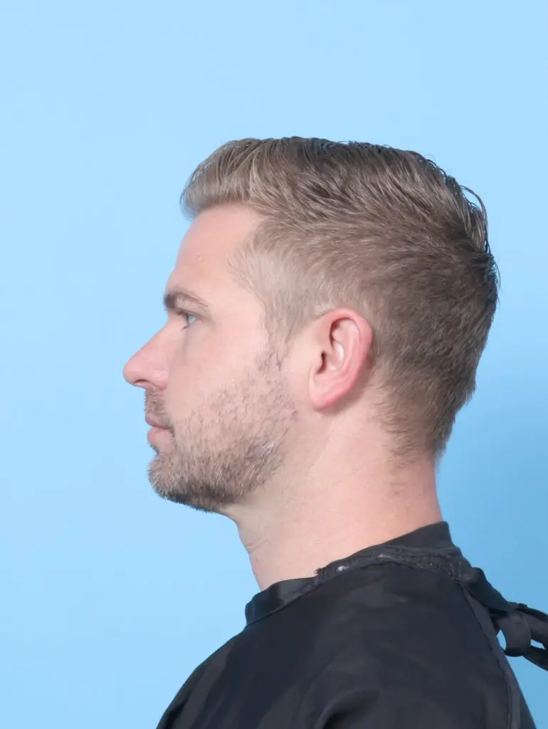 Anterior Neck Lift - Case 59207 - After