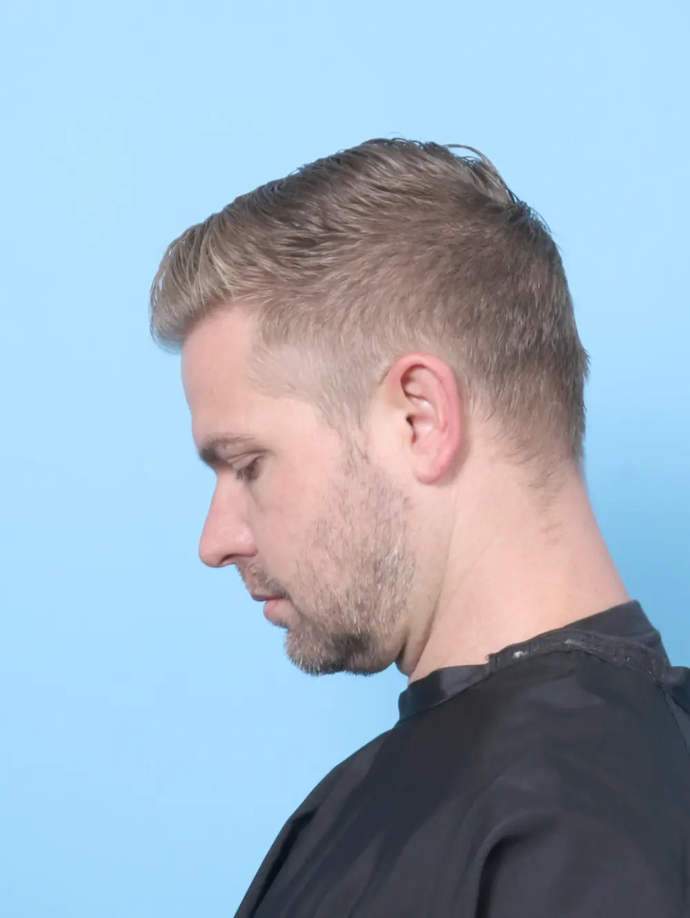 Anterior Neck Lift Patient Photo - Case 59207 - after view-1