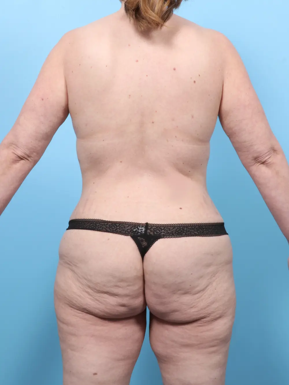After Weight Loss Patient Photo - Case 59217 - before view-3