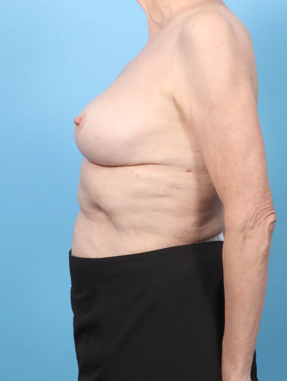 Breast Implant Removal Patient Photo - Case 59227 - after view-2