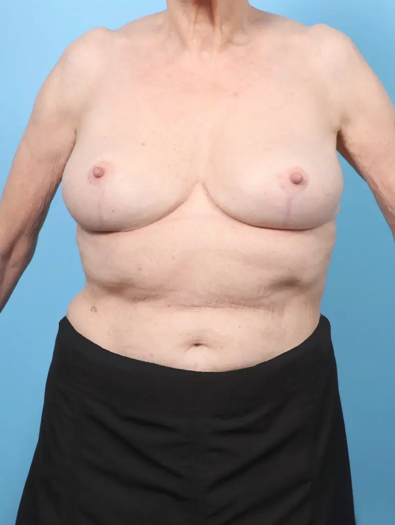 Breast Implant Removal - Case 59227 - After